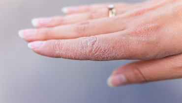 How to Treat Dry Skin Naturally: Tips That Actually Work