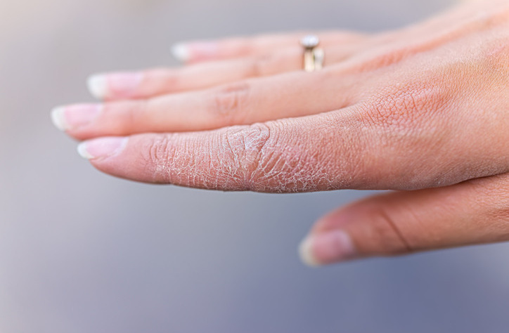 How to Treat Dry Skin Naturally: Tips That Actually Work