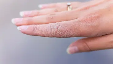 How to Treat Dry Skin Naturally: Tips That Actually Work