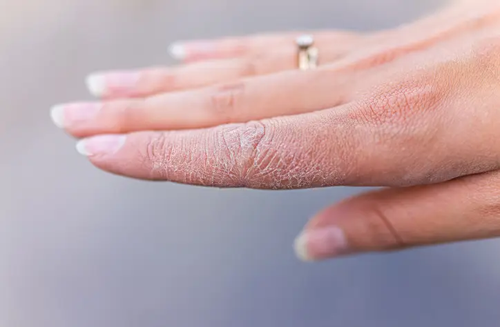 How to Treat Dry Skin Naturally: Tips That Actually Work
